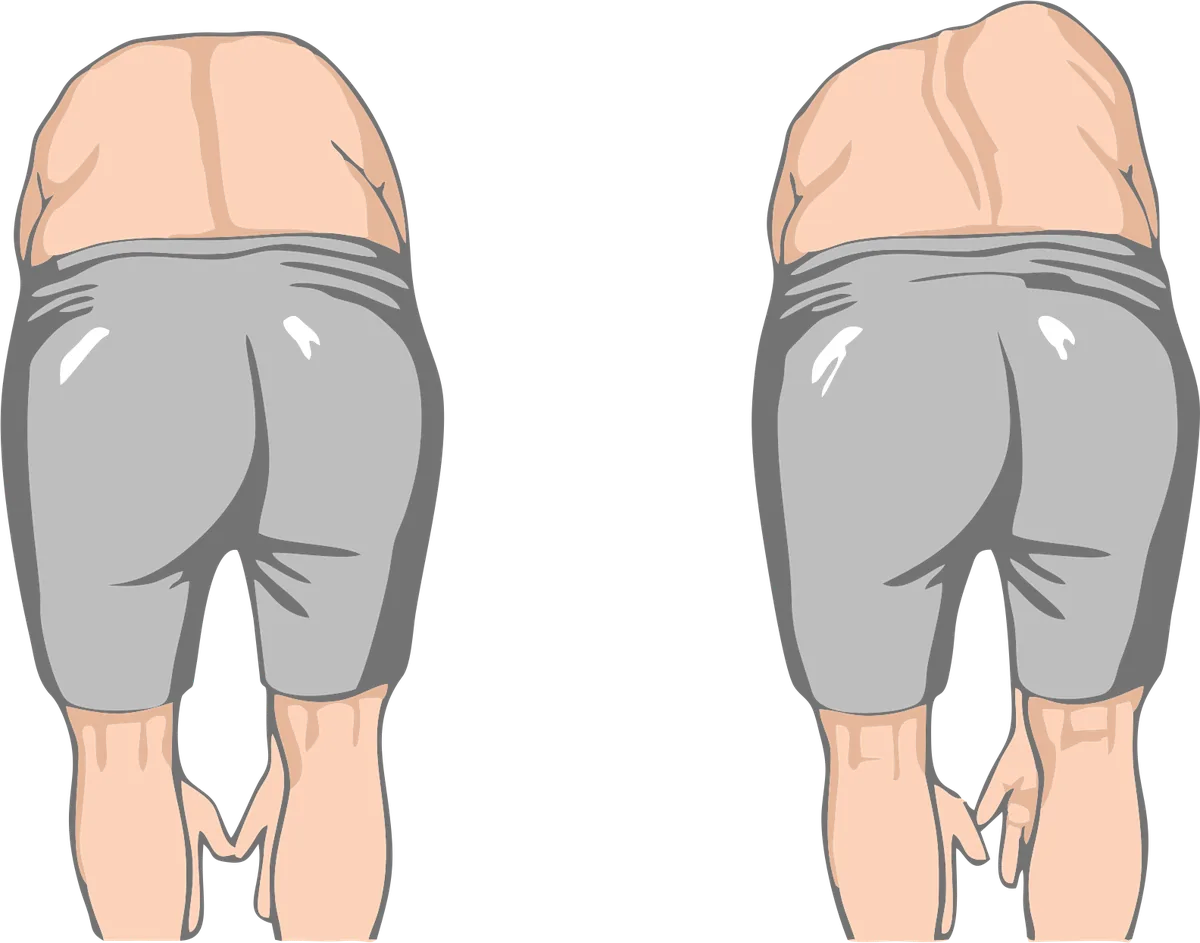 Ilustração do teste de Adams: pessoa inclinada para a frente, vista por trás, mostrando a assimetria do dorso
